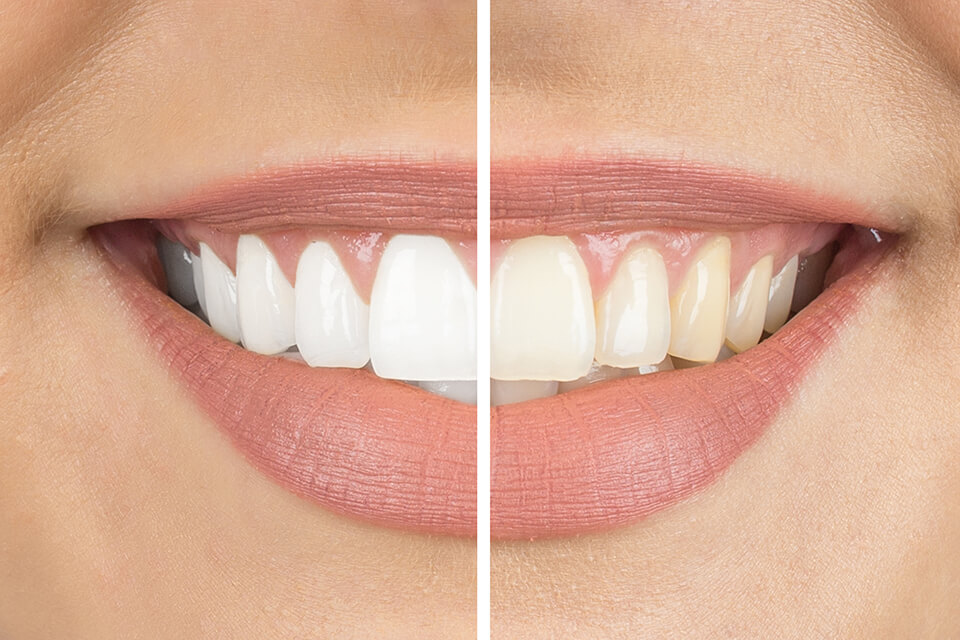 Blanchiment ou Éclaircissement dentaire dans le Gers - Dentiste Saint Clar